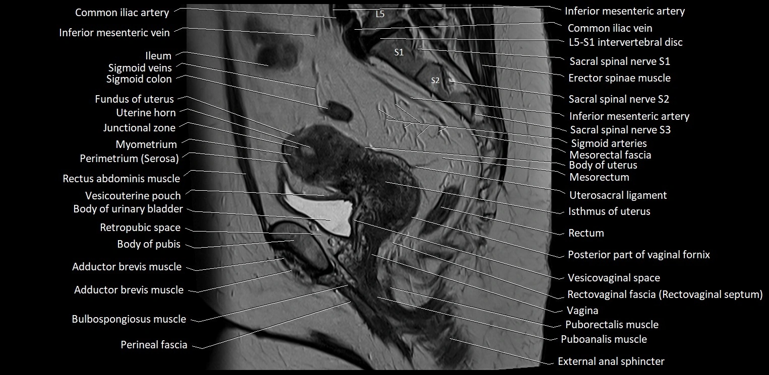 Sagittal cross sectional anatomy of female pelvis (MRI 3T) image 25.webp
